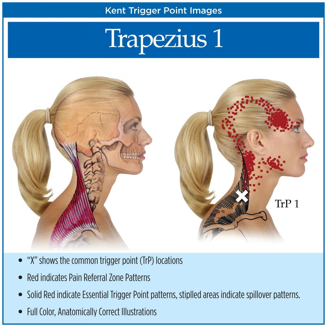 Pain trapezius trigger point points massage therapy neck headaches cause causes myofascial muscle headache chart head cervical muscles ear pattern